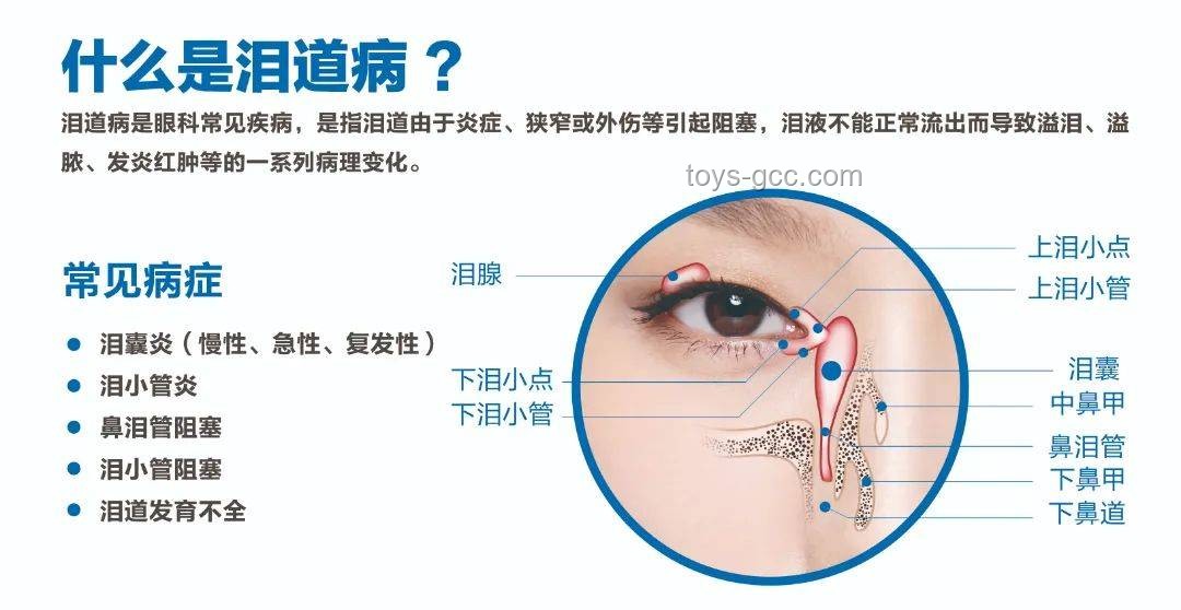 **淚囊異常癥狀對比：女子右眼狂飆淚與常見淚道疾病**
