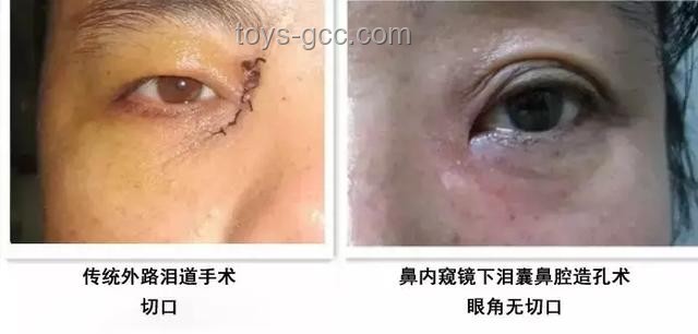 **淚囊異常癥狀對比：女子右眼狂飆淚與常見淚道疾病**