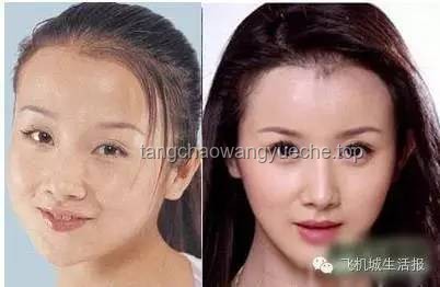 演員孫菲菲整容風波背后的真相：庫欣式綜合征知多少？