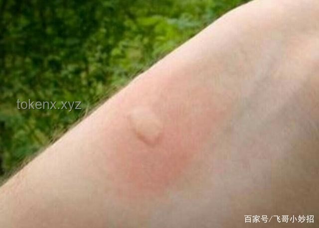 **被蚊子咬了？這4個(gè)迅速止癢的妙招，真心希望你永遠(yuǎn)用不上！**