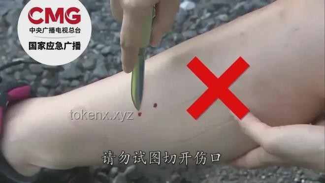 三亞女子被咬身亡救治案例研究：未提蛇咬成關(guān)鍵細(xì)節(jié)