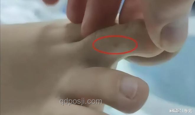 三亞女子被咬身亡救治案例研究：未提蛇咬與救治細(xì)節(jié)