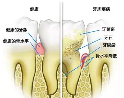 韋東奕牙周炎治療啟示：跨界健康創新之道