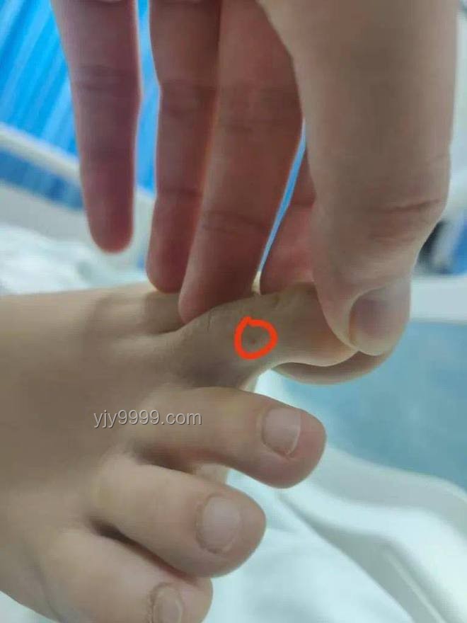 三亞被咬女子神經毒蛇咬傷案例研究