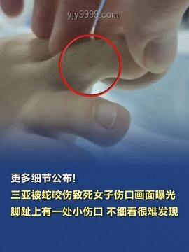 三亞被咬女子神經毒蛇咬傷案例研究