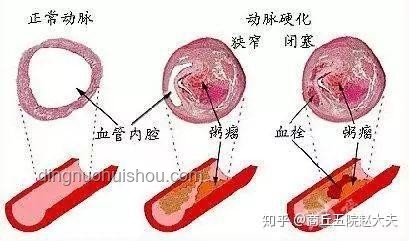 硬化血管“石化”術：醫療創新的取石奇緣