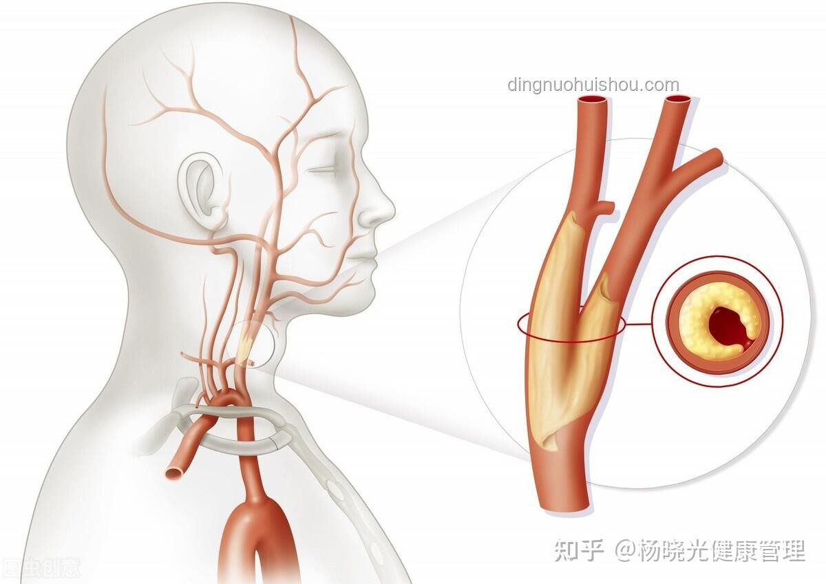 硬化血管“石化”術：醫療創新的取石奇緣