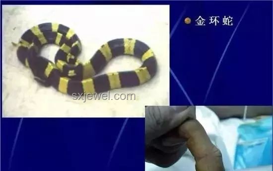 網(wǎng)絡(luò)熱門(mén)長(zhǎng)蟲(chóng)案例：男子40天遭毒蛇7咬生還