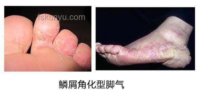 皮膚變厚與腳氣的對比分析