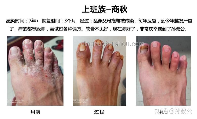 皮膚變厚與腳氣的對(duì)比分析