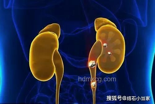 夏季高發腎結石：劇痛案例分析與防治策略
